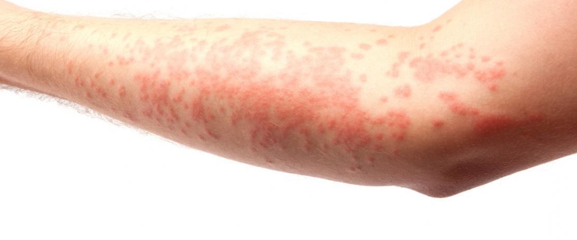 Skin Rashes: Causes, Symptoms, and Treatment