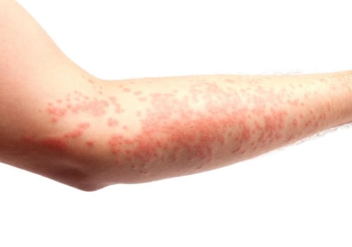 Skin Rashes: Causes, Symptoms, and Treatment